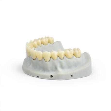 Layer zirconia restorations vs. monolithic zirconia