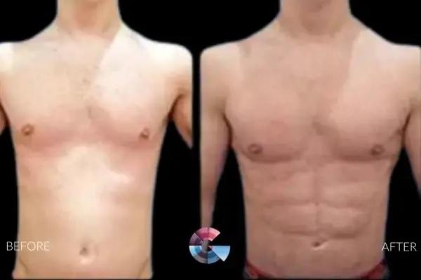 Los Angeles Men Reclaim Confidence Through Advanced Gynecomastia Surgery at Gynecomastia Center of Los Angeles