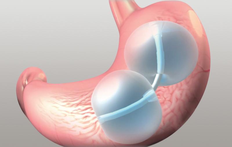 Intragastric Balloon market