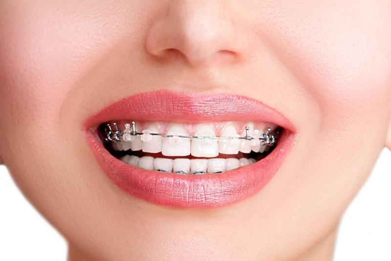 Ceramic Invisible Braces Market to Flourish with an Impressive