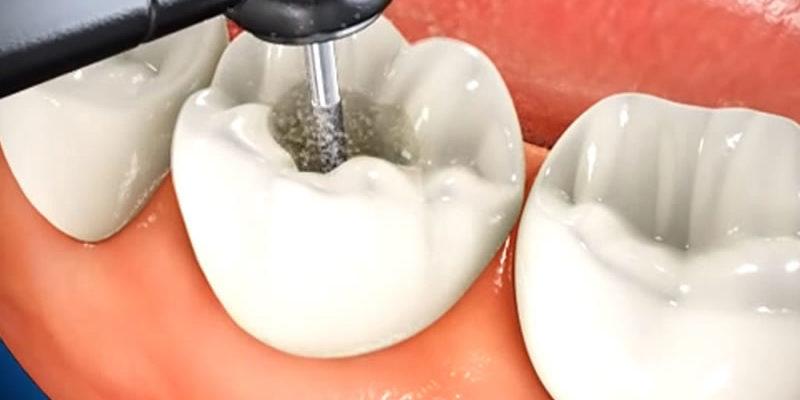 Tooth Filling Materials Market Size & Share – Analysis Report, 2032