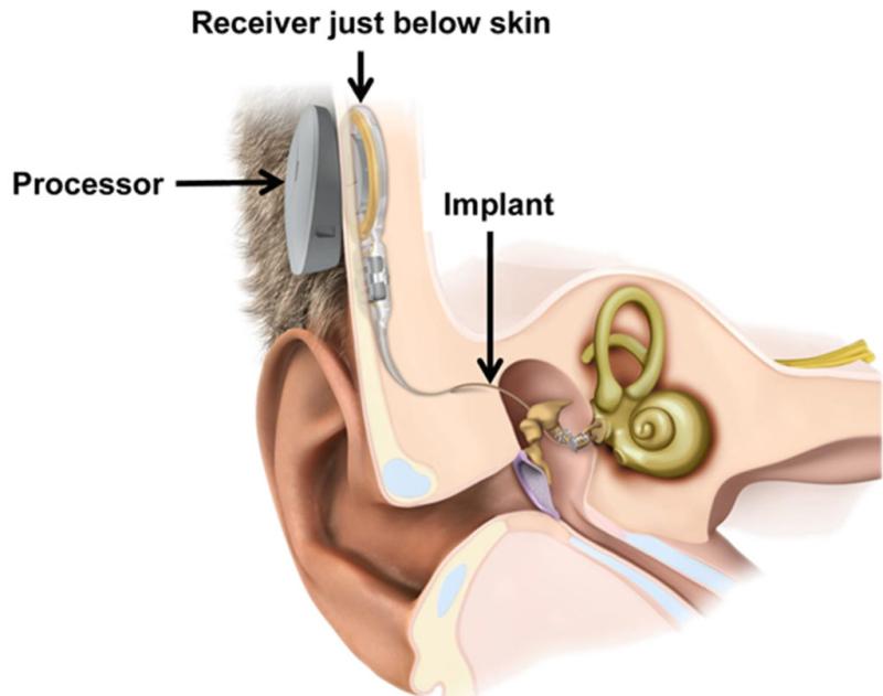 Middle Ear Implants Market