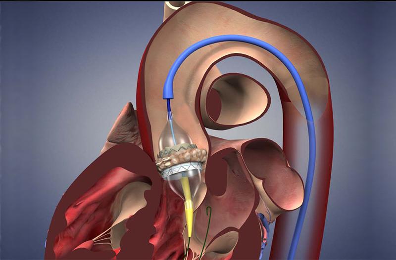 Heart Valve Replacement Market