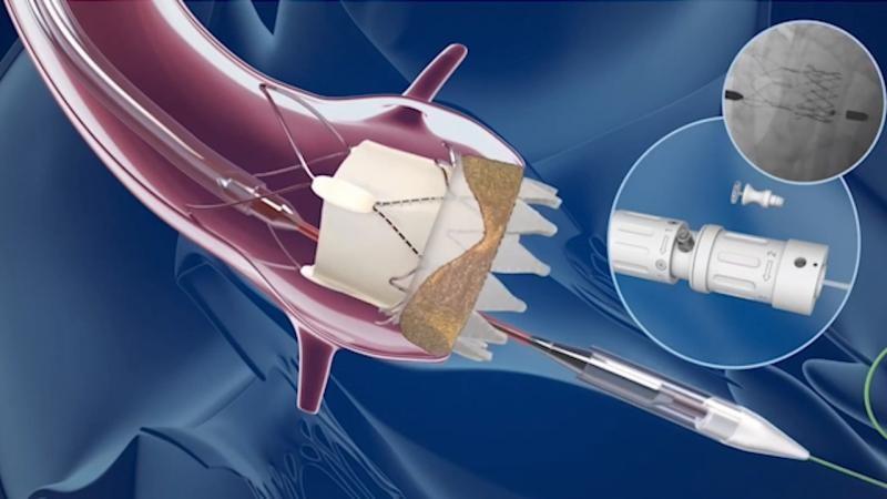 United States Interventional Cardiology Devices Market Report 2024, Size, Share, Trends and Forecast to 2032