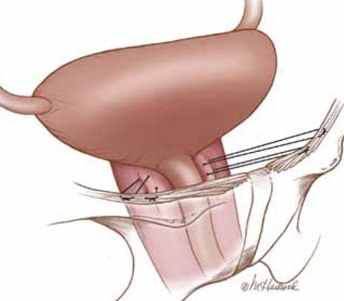 Urinary Incontinence Market