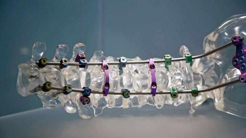 Spinal Implants Market