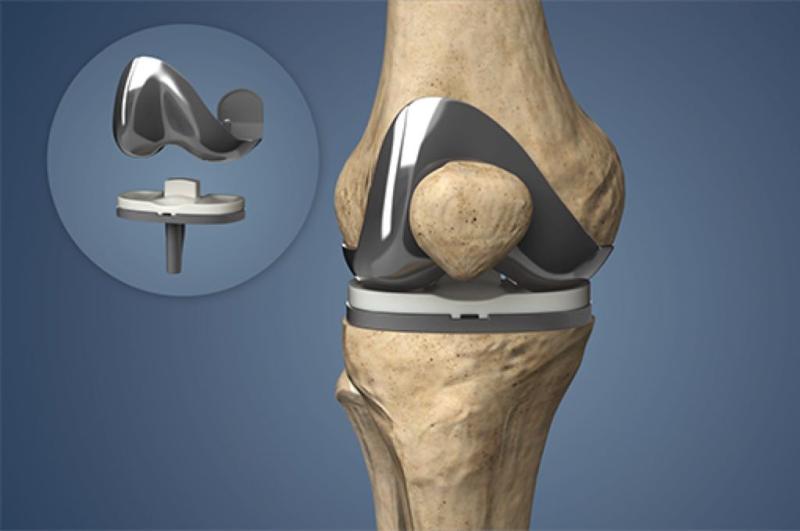 Knee replacement Market