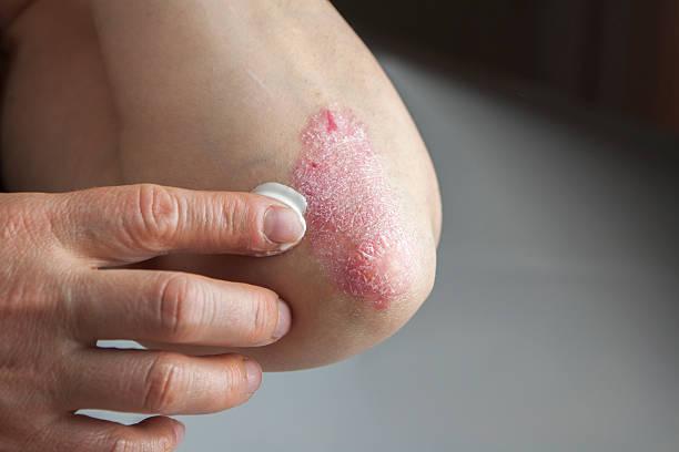 Psoriasis Drugs Market Presents a Strategic Forecast