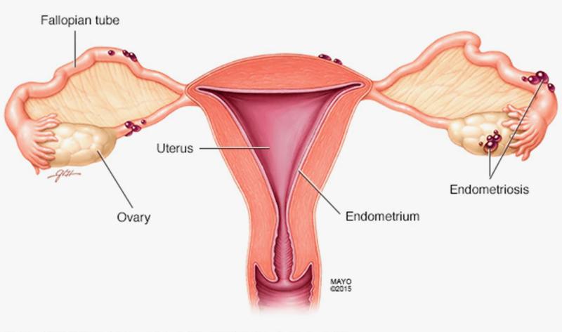 Endometriosis