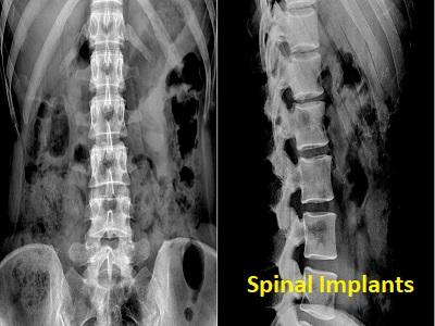 Spinal Implants Market