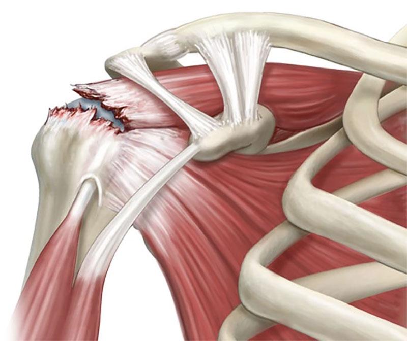 All-Inclusive Rotator Cuff Repair Surgery in Mexico