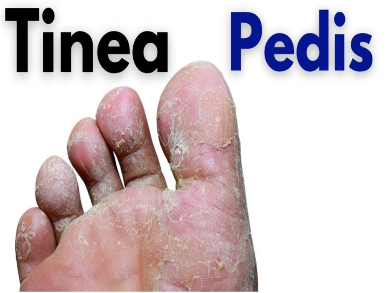 Onychomycosis (Tinea Unguium) Drug Industry Report to 2023 By  Manufacturers, Region And Application