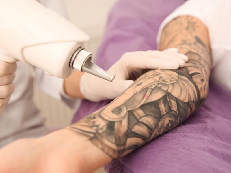 Tattoo Removal – W.I.S.E. Med Center