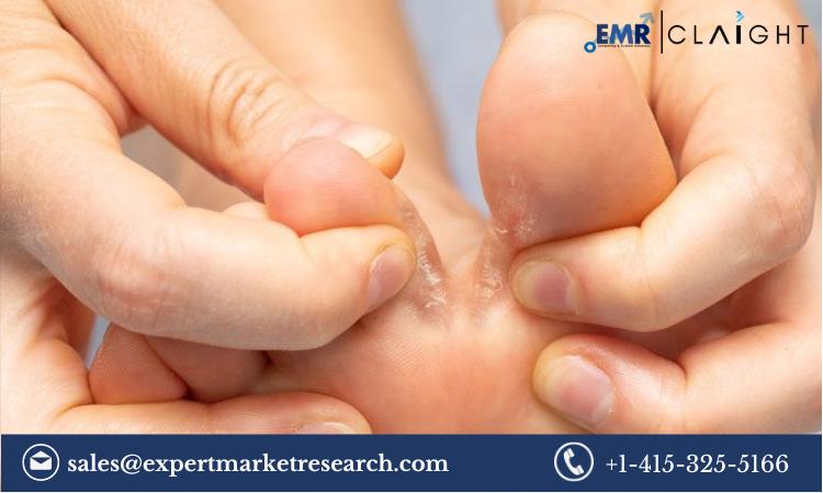 Comprehensive Guide to Athlete's Foot Treatment: Market