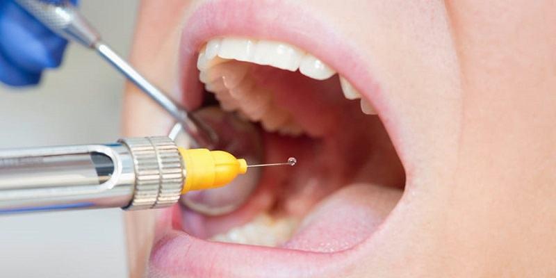 Dental Anesthetics Market to Achieve a Valuation of USD 904.1 million by 2031 | Analysis by Transparency Market Research