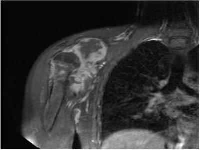 Fibrosarcoma Drugs Market Generated Opportunities, Future