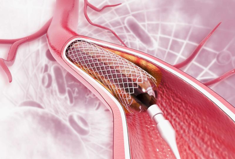Coronary Stents Market Size is Expected to Surpass US$ 25.7 Billion Through 2028| Transparency Market Research Inc.