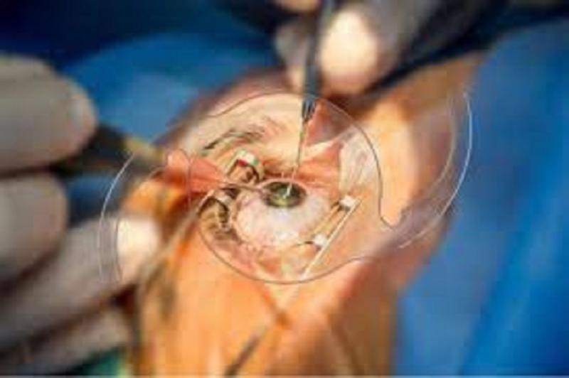 Intraocular Lens Market Growing Popularity & Emerging Trends | Alcon, Inc., Carl Zeiss Meditec, SynergEyes