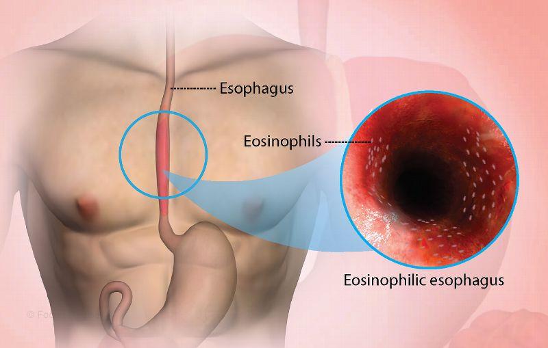 Eosinophilic Esophagitis Market Analysis by Size, Growth