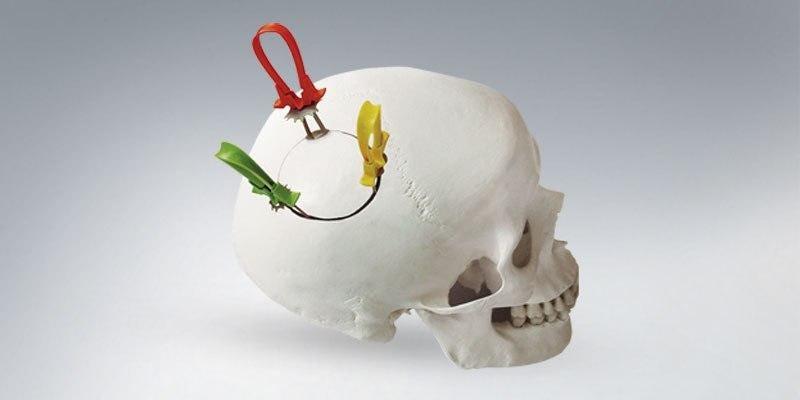 Cranial Fixation and Stabilization Devices Market