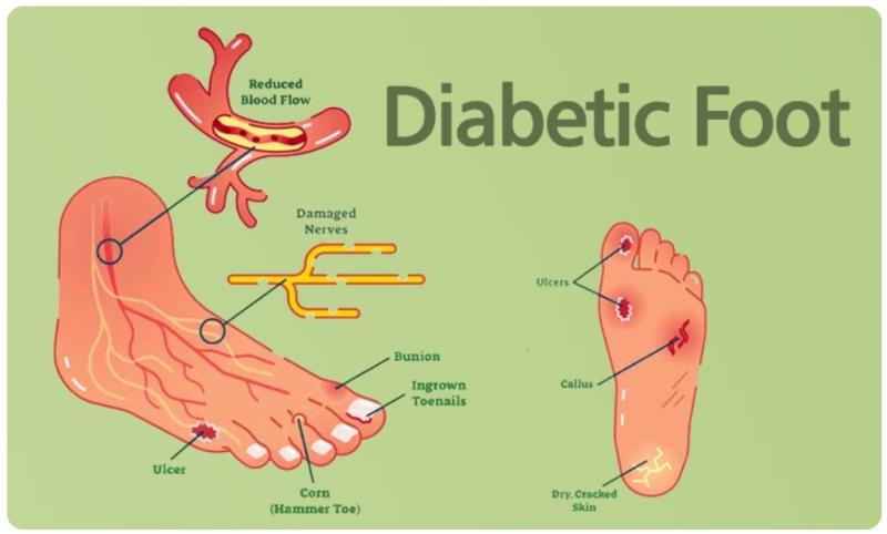 Diabetic Foot Ulcers Treatment Market Sees Surge in Demand, Projected to Reach Over US$ 17.7 Billion by 2031