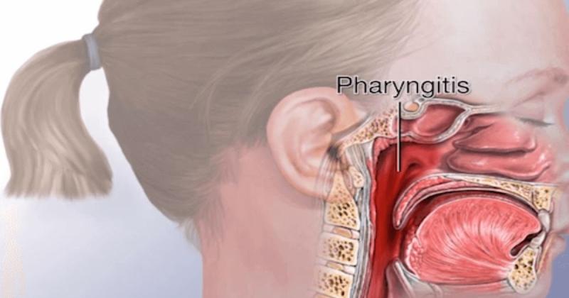 GAS Pharyngitis Propels Diagnostic Market