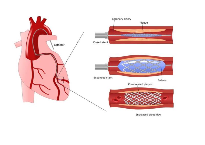 Vascular Stents
