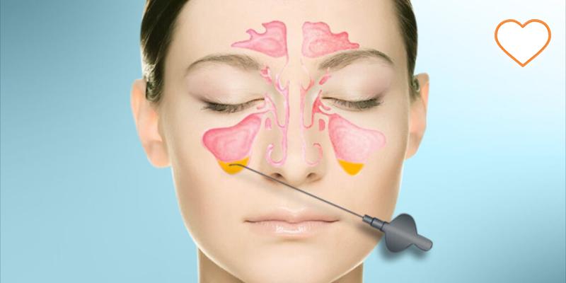 Acute Viral Rhinosinusitis Treatment Market likely to Cross USD