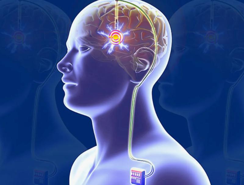 Deep Brain Stimulation Devices