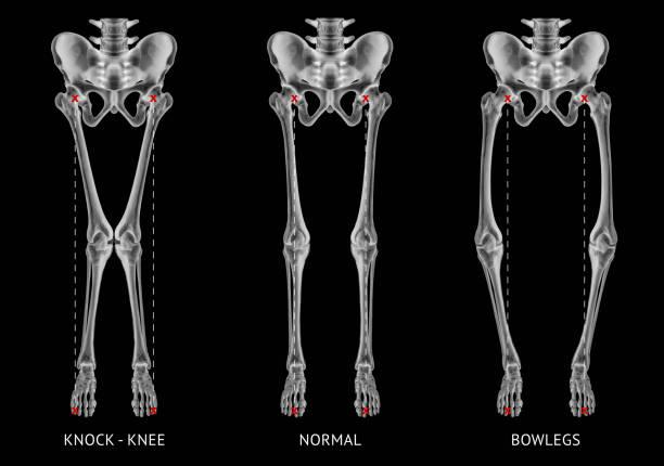 Axial Spondyloarthritis market Trends Unraveled: Insights, Players, and Future Projections 2024-2034