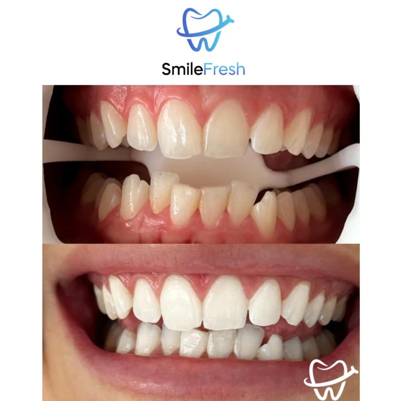 Revolutionizing the Teeth Whitening Experience with Mobile & In-Studio Services Across Australia