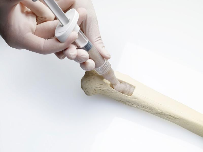 Bone Graft Substitutes Market