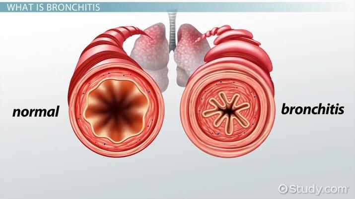 Bronchitis Treatment Market