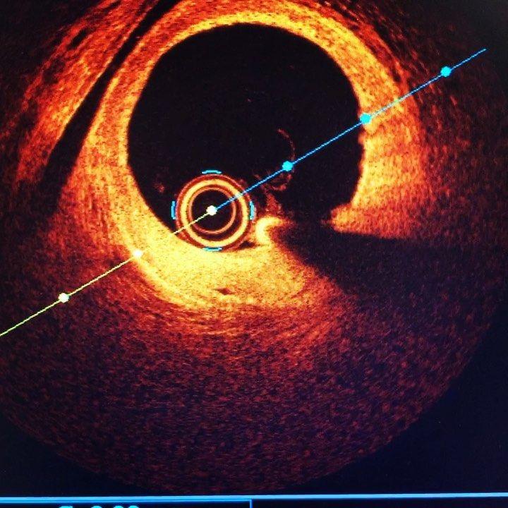 Optical Coherence Tomography Market