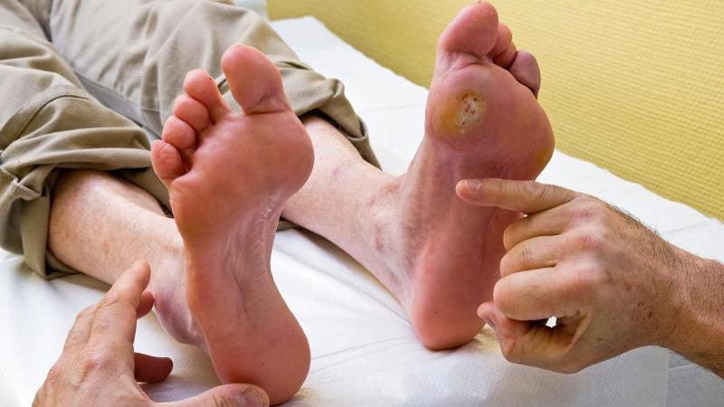 Diabetic Foot Ulcer Treatment Market