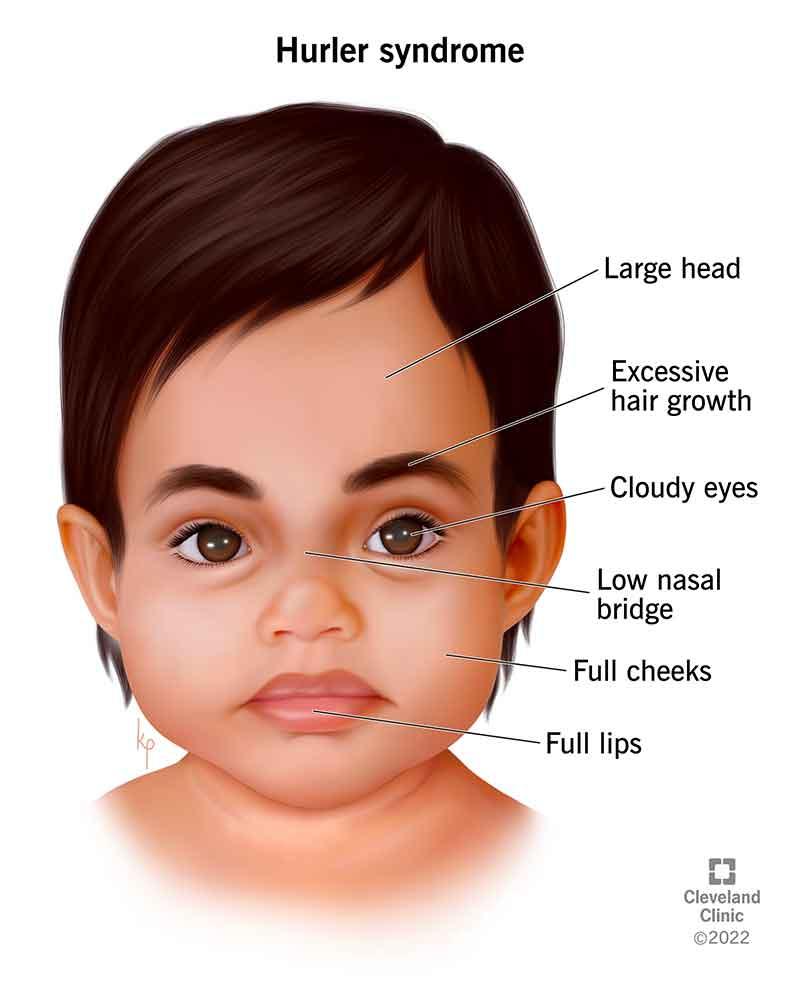 Hunter Syndrome Treatment Market