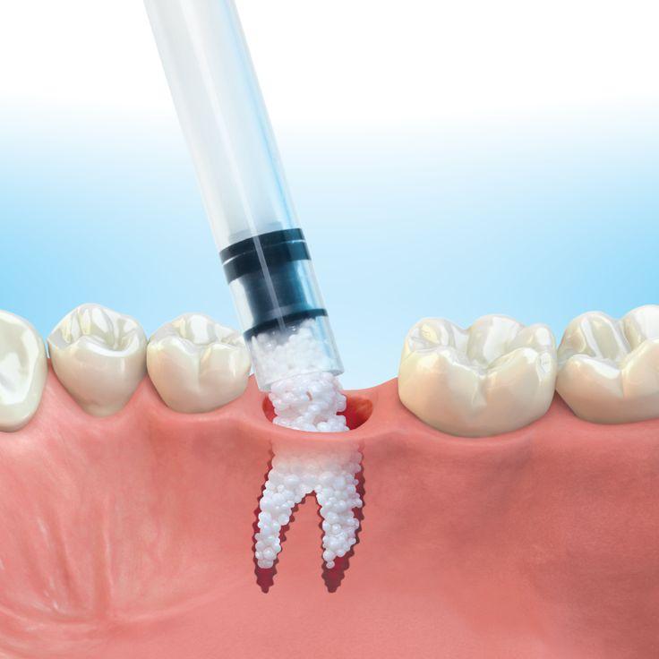 Dental Bone Void Filler