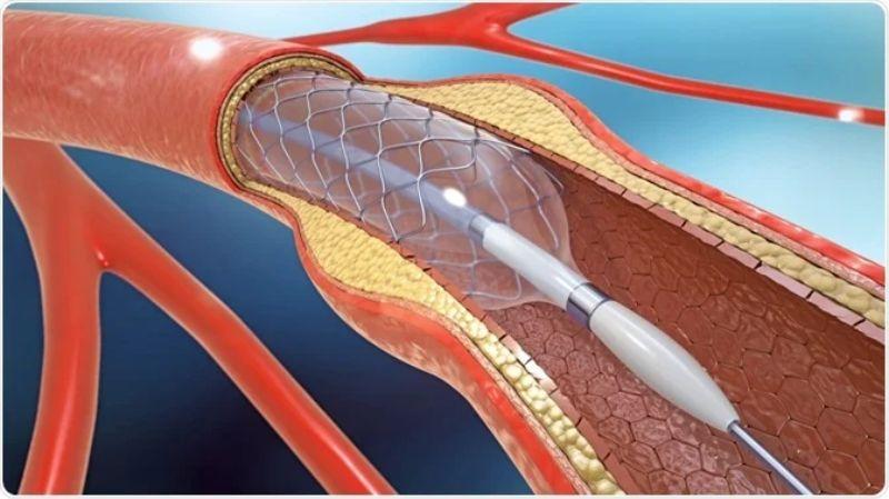 Drug Eluting Stents Market Scope, Growth, Comprehensive