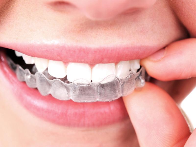 Dental Aligners Market