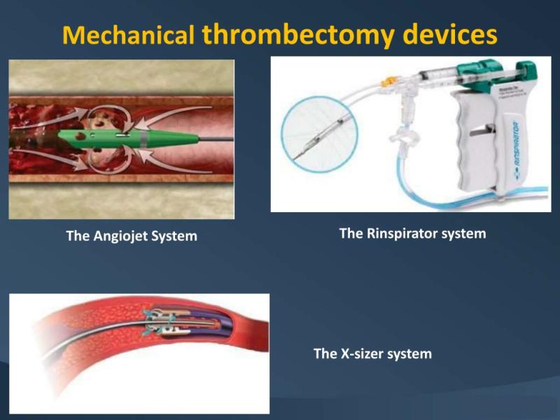 Mechanical Thrombectomy Devices