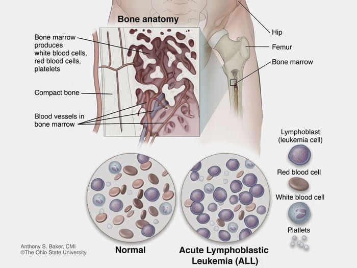 [At a CAGR of 7.6%], Acute Lymphoblastic Leukemia Market Size