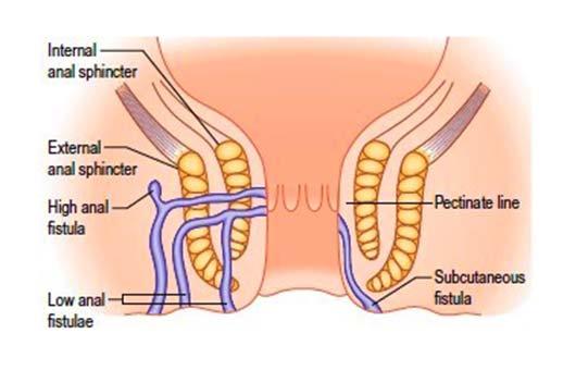 Recto-vaginal Fistula Treatment Market