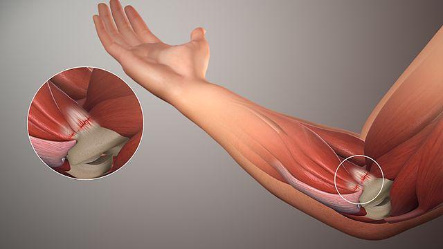 Tendinitis Treatment Market