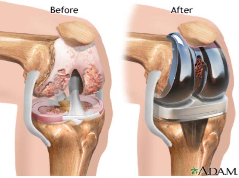 Bone Replacement Market