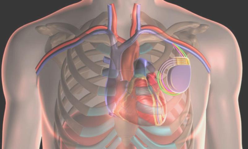 Cardiac Resynchronization Therapy Market