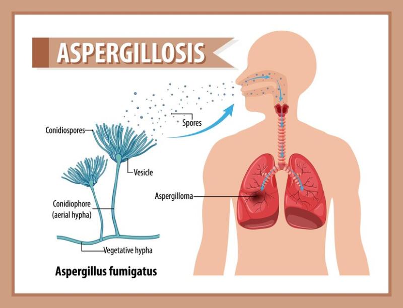 Global Aspergillosis Treatment Drug Market was valued at 4897 million in 2024 and is projected to reach US$ 6488 million by 2033