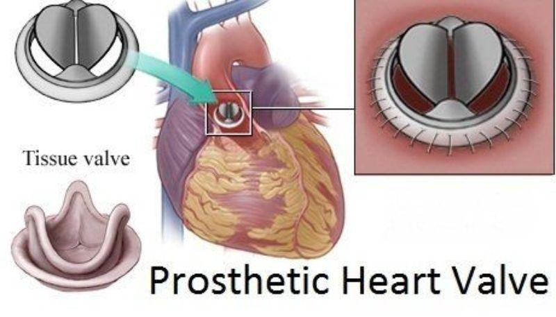 Prosthetic Heart Valve Market Current Insights, Regional