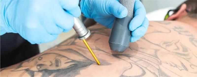 Tattoo Removal Market