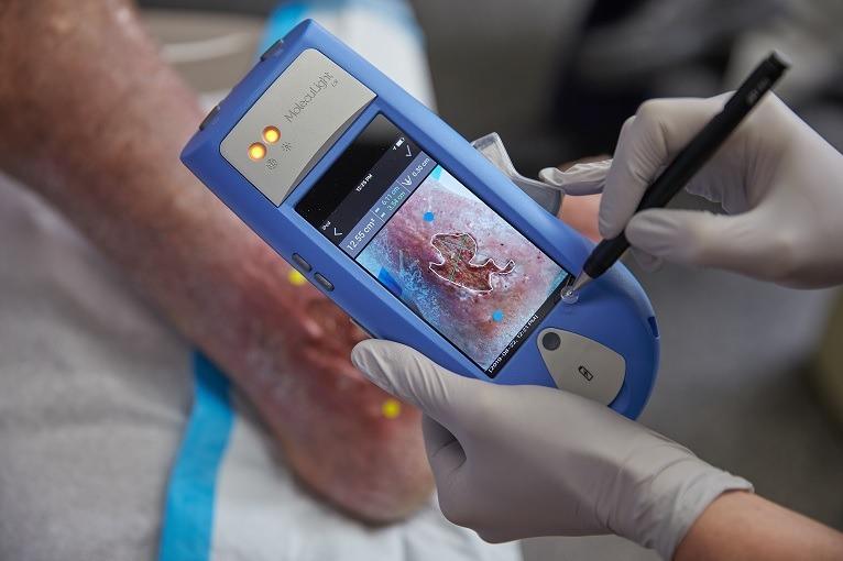 Digital Wound Measurement Devices Market