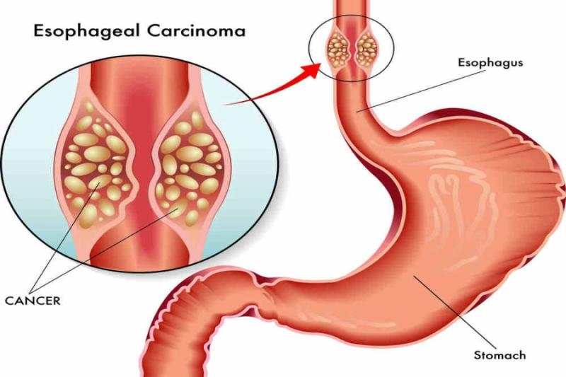 Esophageal Cancer Drugs Market